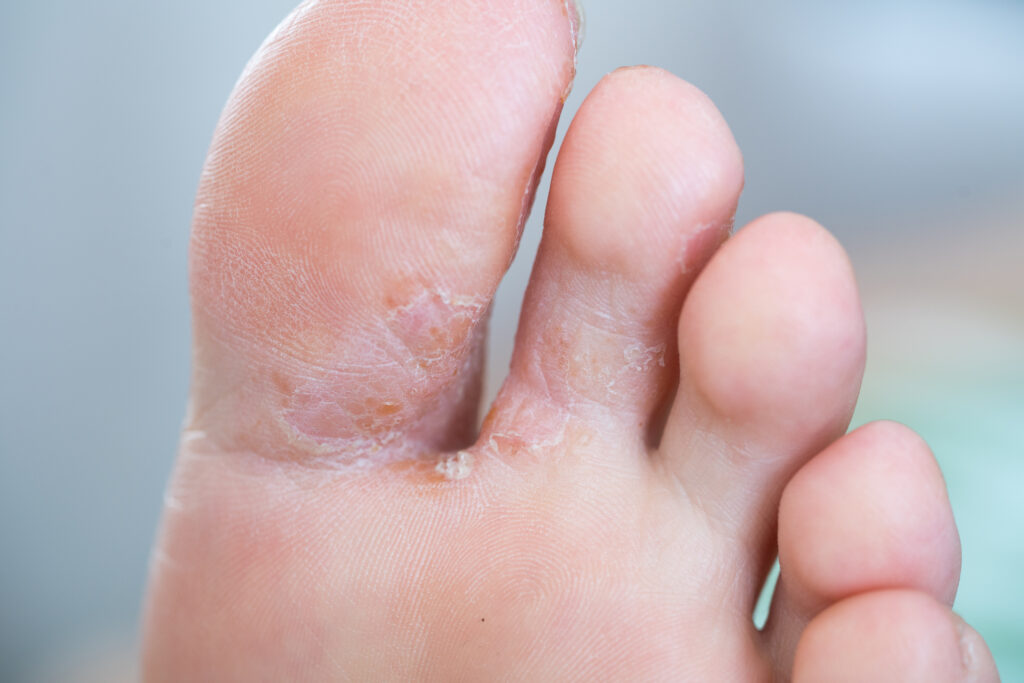 Athlete’s foot infection