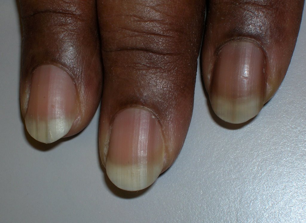 dark fingernail