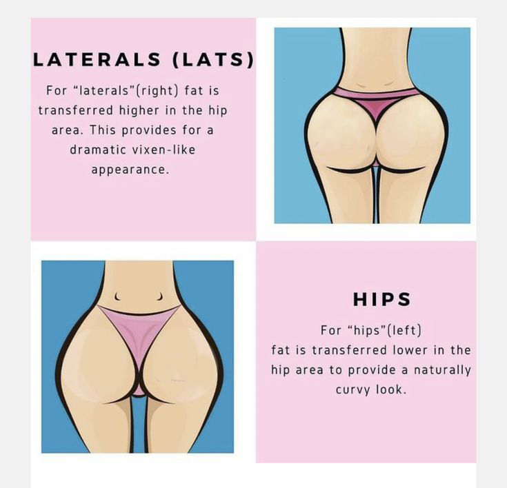 hips vs lats in BBL